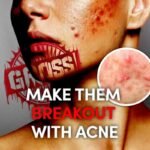 Make Them Breakout With Acne Spell